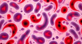 A group of normal cells mixed with sickle cells.